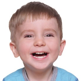 Tooth Extractions
